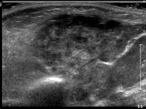 parotitis - Pediatric Imaging