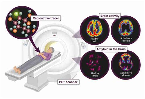 All you need to know about brain scans and dementia - Alzheimer's ...