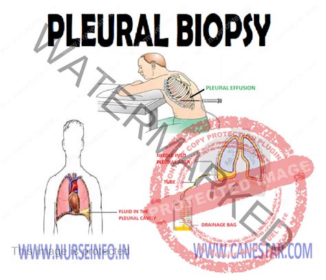 PLEURAL BIOPSY - Nurse Info