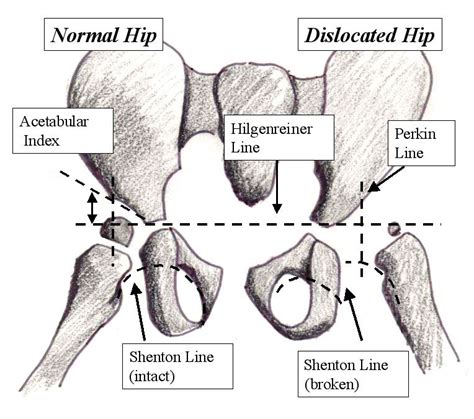 Developmental Dysplasia of the Hip | Developmental dysplasia of the hip ...