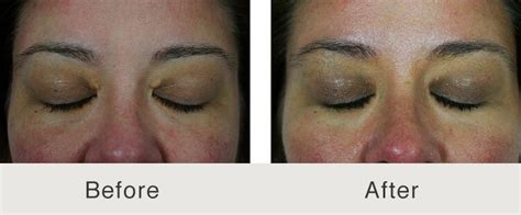 Xanthelasma Treatment and Excision by Facial Plastic Expert