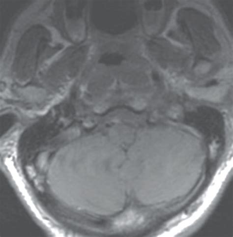 MRI assessment of the jugular foramen. Sagittal (a) and axial (b) MRI ...