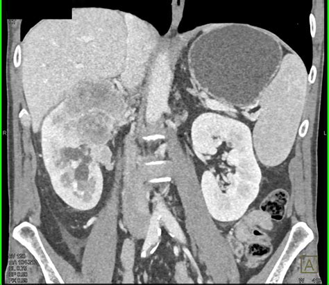 Clear Cell Renal Cell Carcinoma Invades the Renal Vein and Inferior ...