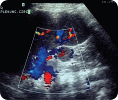 Ultrasound images of Splenomegaly - Radiology Imaging