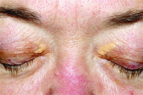 Lasers may be effective for treating xanthelasma | MDedge Dermatology