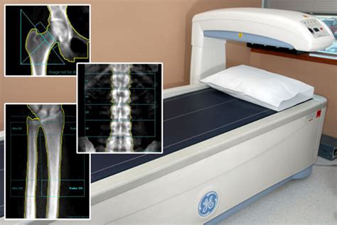 DXA Scanning - Carroll Arthritis, LLC