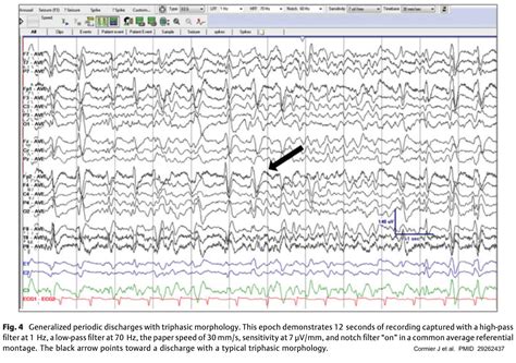 Normal Versus Abnormal Eeg