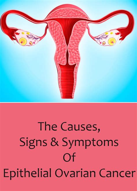 The Causes, Signs And Symptoms Of Epithelial Ovarian Cancer | Lady Care ...