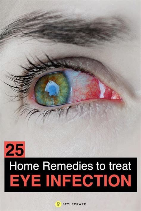 Home Remedies To Treat Sore Eyes – 14 Methods + Prevention Tips | Eye ...