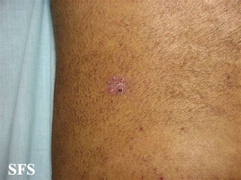 Primary cutaneous amyloidosis - wikidoc