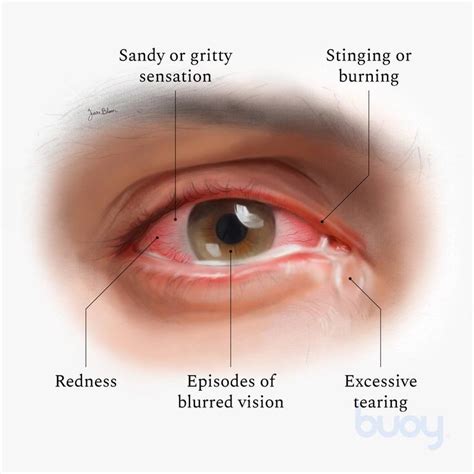 What Is Dry Eye Syndrome (Dry Eyes Disease)?