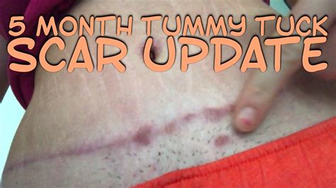 Tummy tuck belly button with scar - camerafery