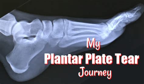 Plantar Plate Tear Injury – Joyful Miles