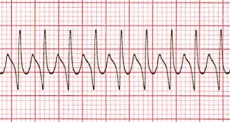 Supraventricular tachycardia strip