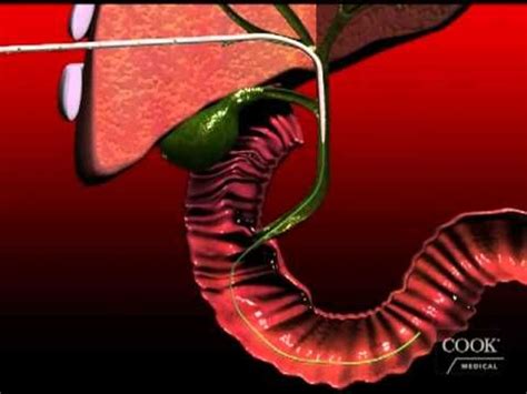 Biliary Drainage: Catheter insertion animation | Catheter insertion ...