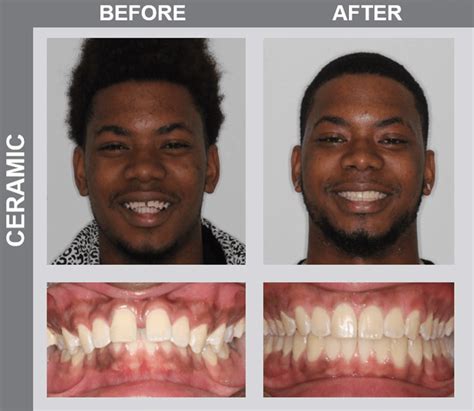 Teeth Before And After Braces Crowding