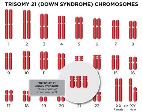 Trisomy 21 (Down Syndrome): Diagnosis & Expectations