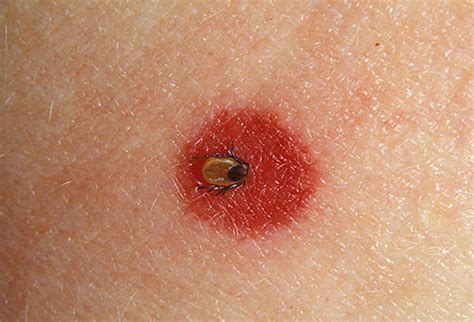 Tick Bite - Pictures, Symptoms, Removal, Treatment | Deer Tick Bite ...