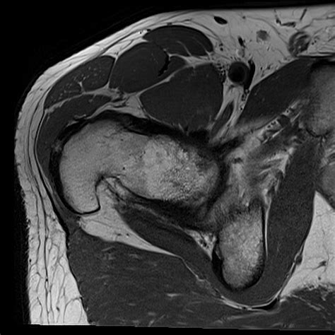 normal hip MRI axial view 2 Diagram | Quizlet