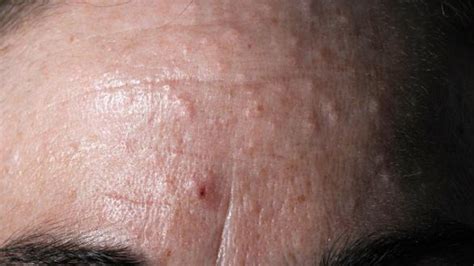 Sebaceous Hyperplasia - Treatment, Photos, Removal, Causes