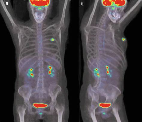 Pet Ct Scan For Kidney Cancer - CancerWalls