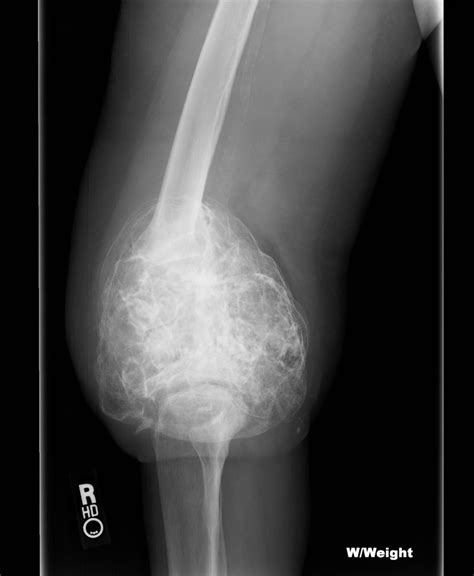 Osteoblastoma | Radiology Case | Radshare.net