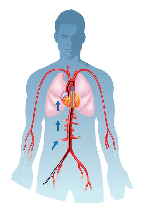 Coronary Angiogram/Angioplasty Pre-procedure guide - CVSKL