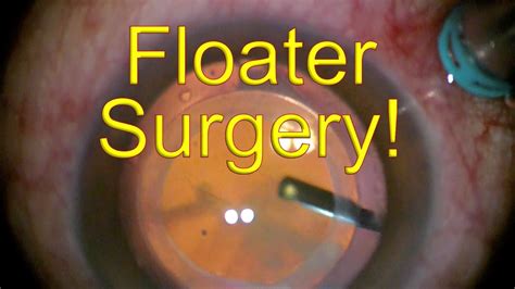 Does Vitrectomy Remove All Floaters? Quick Answer - Chiangmaiplaces.net