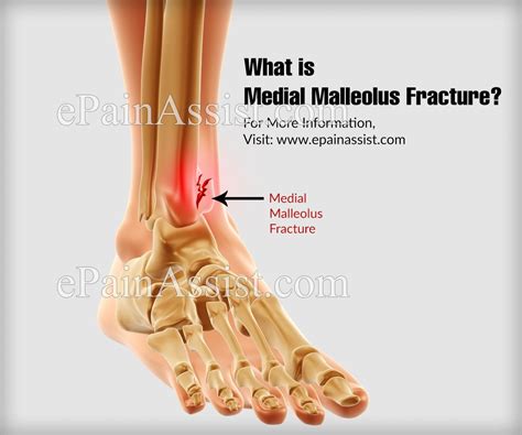 Malleolus Fracture / Operative Treatment Of Posterior Malleolar ...