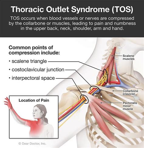 Thoracic Outlet Syndrome | Chiropractor in Wilmington, NC | Galligan ...