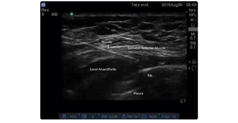 Húmedo Puede soportar Culpa serratus anterior nerve block absorción ...