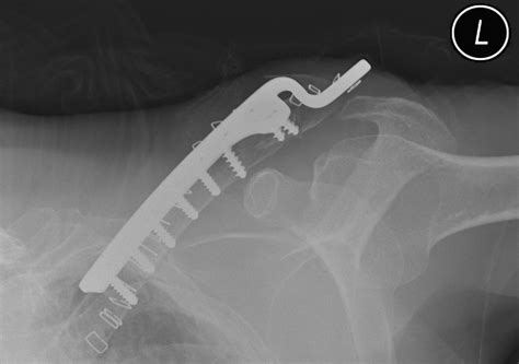 Clavicle Fractures - Distal - Trauma - Orthobullets