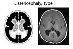 Medical Treatment Pictures-for Better Understanding: Lissencephaly