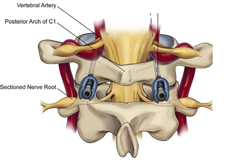 Vertebral Artery Injury - Spine - Orthobullets