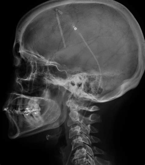 Ventriculoperitoneal (VP) Shunt Catheters - MR IMPLANT