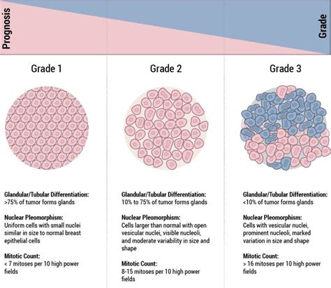 Staging & Grade - Breast Cancer | Johns Hopkins Pathology