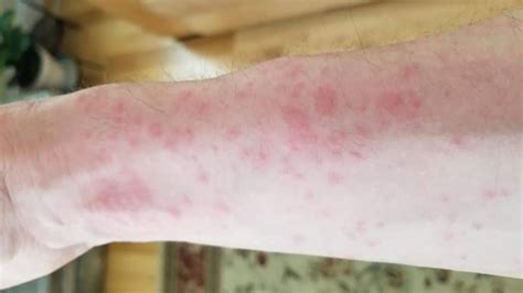 How I Treated My Browntail Moth Rash