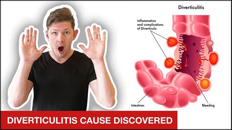 Diverticulitis Causes Symptoms And Treatment Netmeds