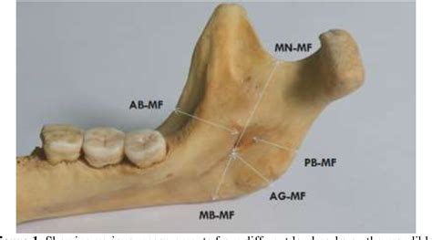 Figure 1 from A morphometric study of the mandibular foramen in dry ...