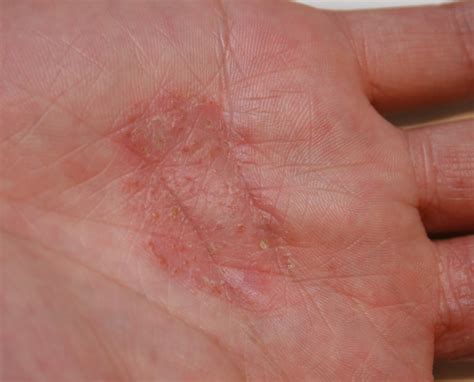 Eczema - Take care of those hands! - Dr. Trevor Erikson