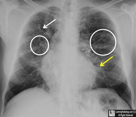 LearningRadiology - cystic, fibrosis, mucovicidosis Portal Hypertension ...