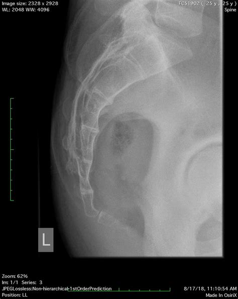 Acute coccyx angle : r/Radiology