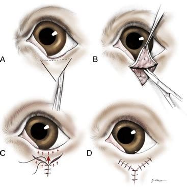 What Is Entropion Surgery