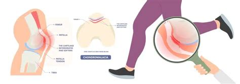 Chondromalacia Patella Treatment • Harmony Chiropractic