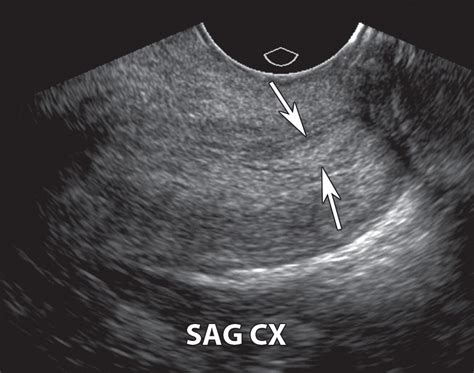 US of the Nongravid Cervix with Multimodality Imaging Correlation ...