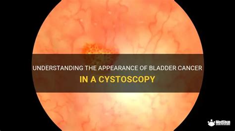 Understanding The Appearance Of Bladder Cancer In A Cystoscopy | MedShun