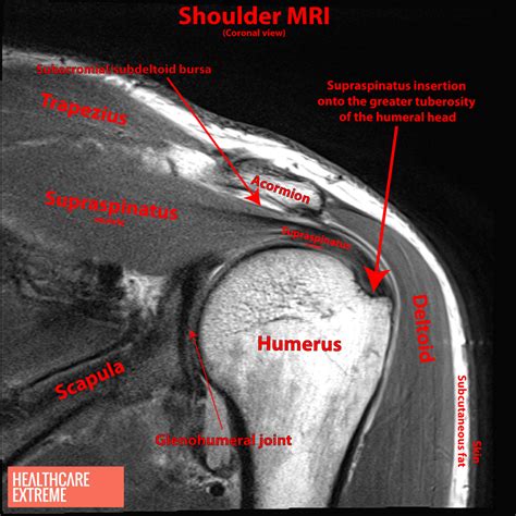 Shock And Suspense With Shoulder Subacromial Impingement Syndrome ...