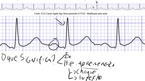 Descomplicando o ECG - Aula 10 - Arritmia sinusal, taquicardia sinusal ...