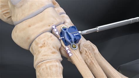 Arthrex - 2nd TMT Arthrodesis With DynaNite® Compression Plate and ...