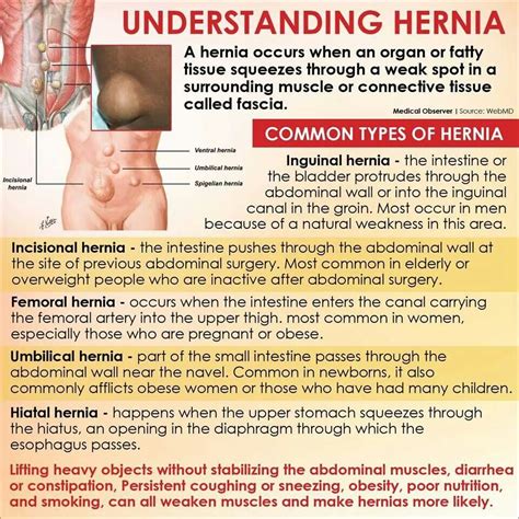 Understanding Hernia | Hernia inguinal, Abdominal, Bladder